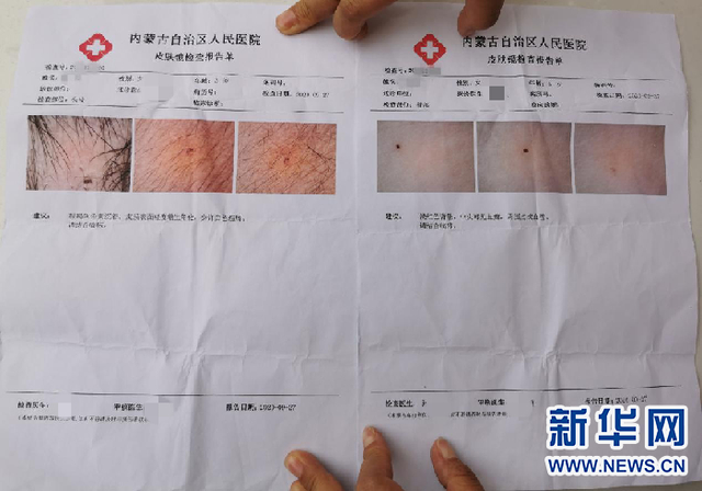 不止一个孩子!孩子身上现针眼幼儿园园长被免,到底是谁干的?