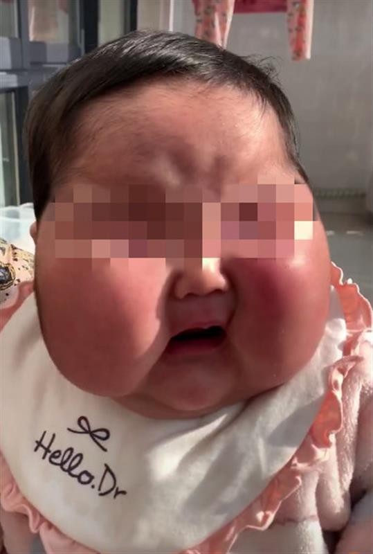 太可怕了!5月大婴儿用抑菌霜后成大头娃娃 有发育迟缓、多毛、脸肿大等症状