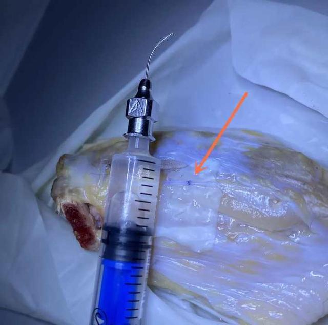 用心呵护生命！浙江这位用“鸡翅膀”研究最佳缝合方案的医生火了