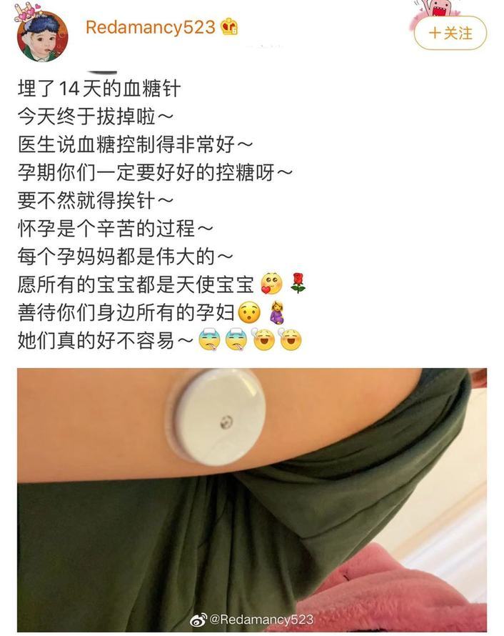 母爱太伟大了!杜淳老婆孕期肚皮埋血糖针14天