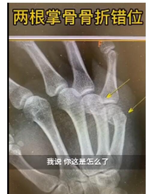 爸爸辅导孩子作业，生气捶墙致骨折 感同身受的“痛”