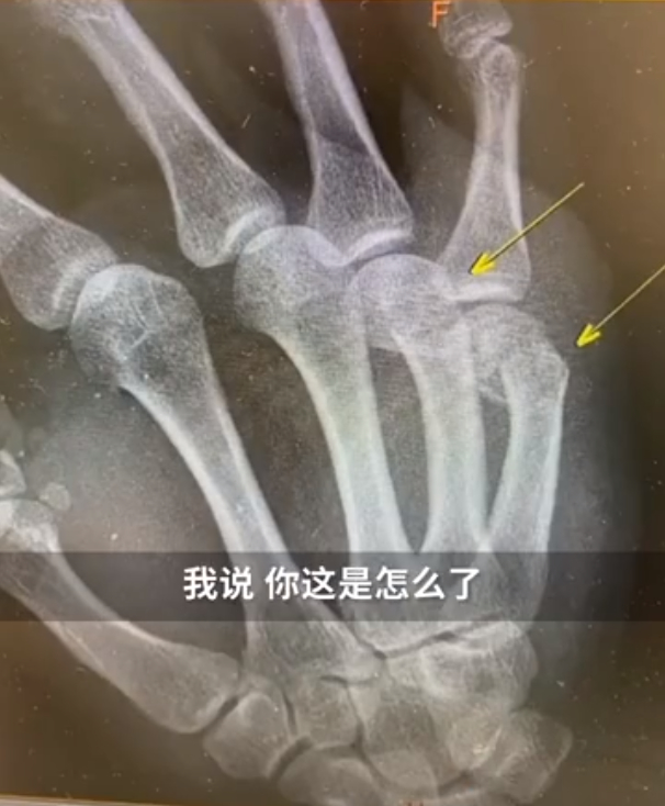 一写作业鸡飞狗跳!爸爸辅导孩子作业生气捶墙致骨折 网友分享心酸“血泪史”