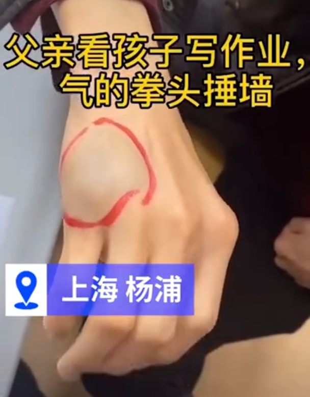 一写作业鸡飞狗跳!爸爸辅导孩子作业生气捶墙致骨折 网友分享心酸“血泪史”