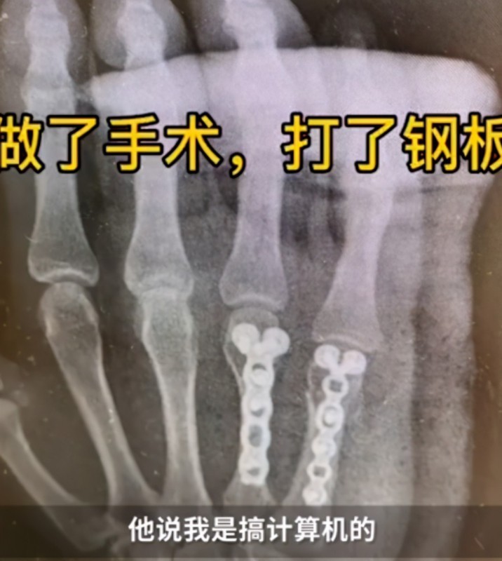 一写作业鸡飞狗跳!爸爸辅导孩子作业生气捶墙致骨折 网友分享心酸“血泪史”