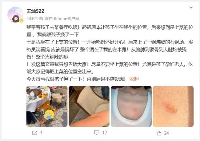 杜淳妻子自曝带娃吃饭被烫 皮肤红肿锁骨处起水泡